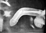 Penis-fracture-xray-medical-joke.jpg