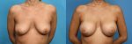 Breast-Augmentation-Dr.-Bruce-Van-Natta-436.jpg